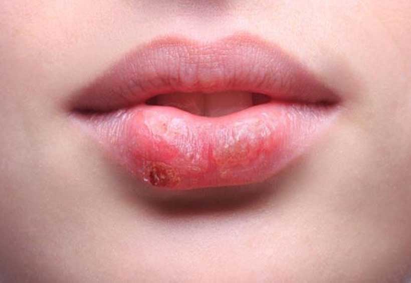 Herpes, enfermedad contagiada por besos. Noticias en tiempo real