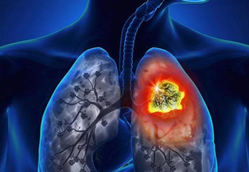 Datos que debes conocer del cáncer de pulmón. Noticias en tiempo real