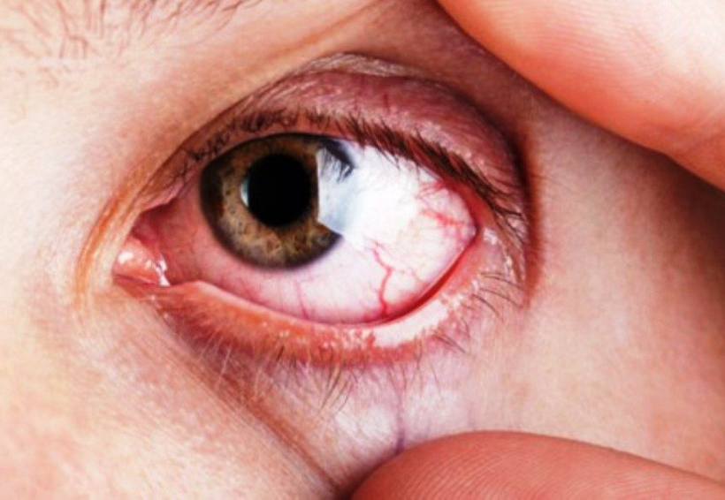 Glaucoma, enfermedad que no presenta síntomas. Noticias en tiempo real