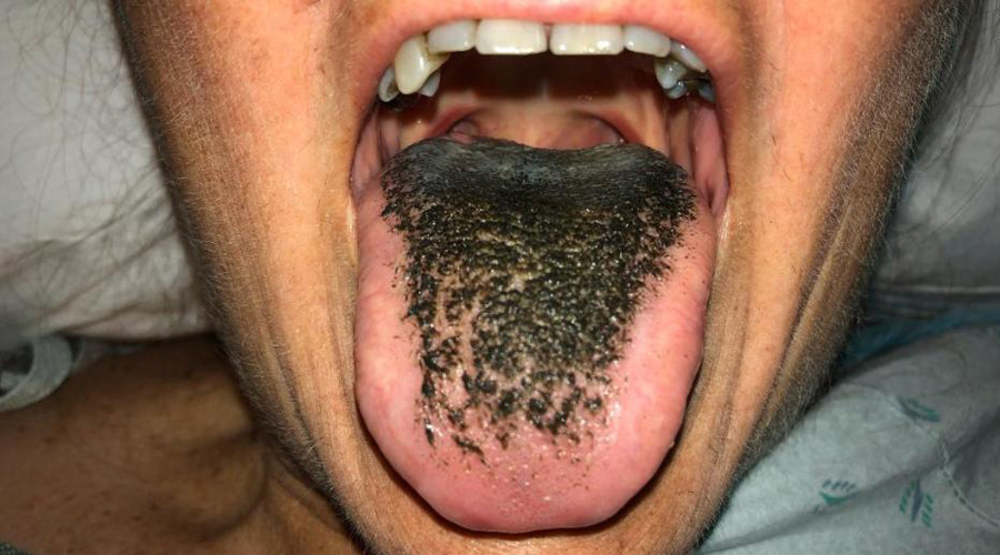 ¿En qué consiste la extraña condición de la lengua ‘peluda’?. Noticias en tiempo real