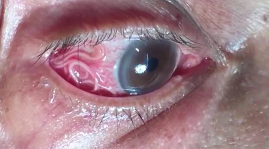 Video:  Médico remueve un gusano de 15 cm del ojo de un hombre. Noticias en tiempo real