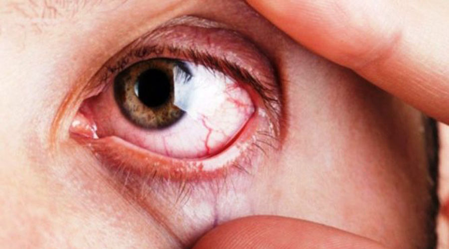 Los nuevos tratamientos para combatir el glaucoma | El Imparcial de Oaxaca Los nuevos tratamientos para combatir el glaucoma | El Imparcial de Oaxaca