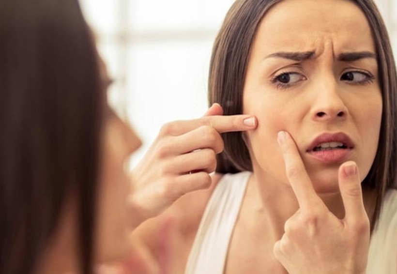 Por qué el acné entre adultos se ha vuelto relativamente común | El Imparcial de Oaxaca