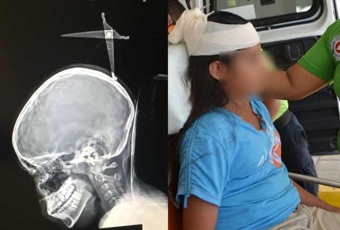 Niño de 4 años clava tijeras a su hermana en la cabeza porque lo regañó | El Imparcial de Oaxaca