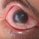 Día Mundial del Glaucoma; 5 de cada 10 personas podrían sufrir ceguera