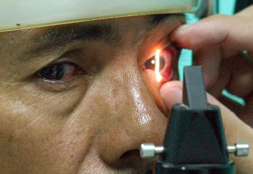 Ceguera por edad es curada con células madre | El Imparcial de Oaxaca