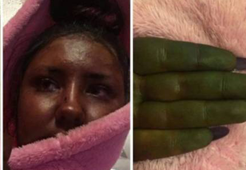 Su piel se pone completamente verde por culpa de un bronceador | El Imparcial de Oaxaca