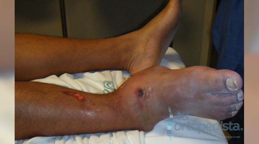 Hombre es arrollado y sufre fractura de tobillo en Huajuapan, Oaxaca | El Imparcial de Oaxaca