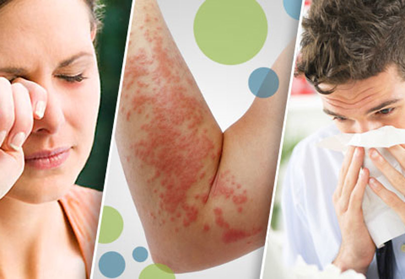 Alergias, lo que debes saber