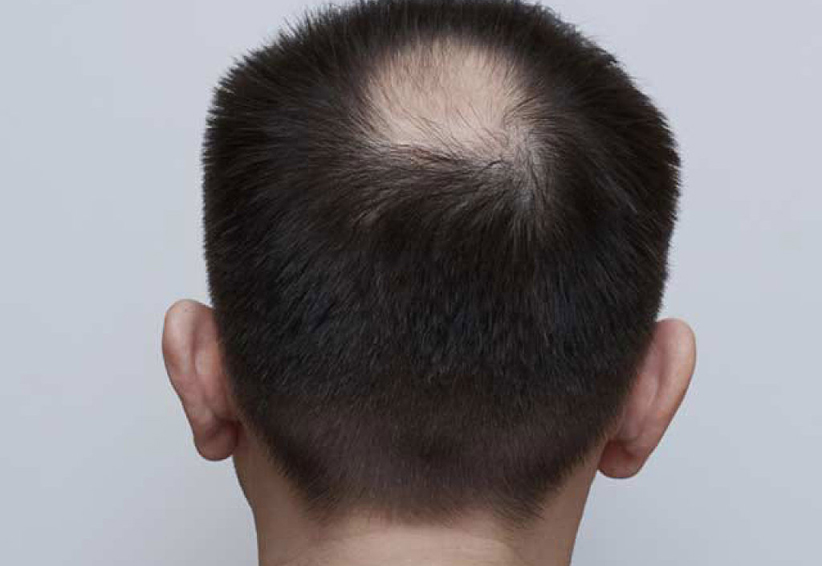 ¿Pierdes cabello? Podría ser alopecia, conoce sus características | El Imparcial de Oaxaca