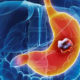 Factores de riesgo para cáncer de estómago