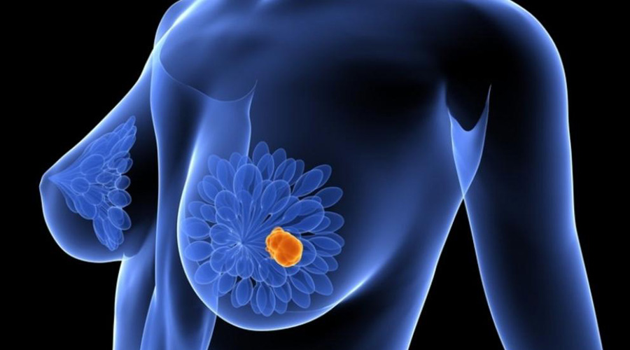 Tipos de operación contra el cáncer de mama | El Imparcial de Oaxaca