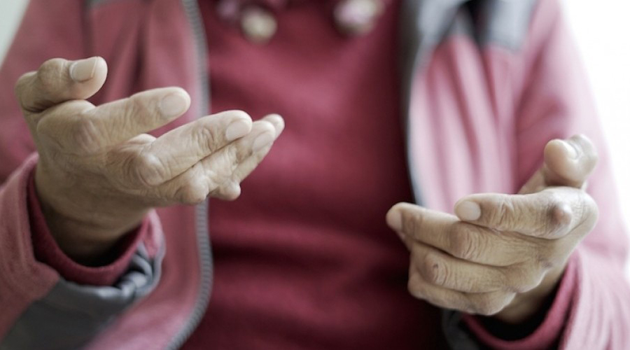 Artritis reumatoide puede afectar salud pulmonar | El Imparcial de Oaxaca