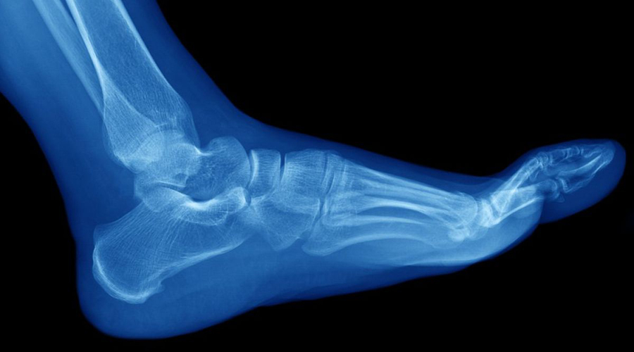 Mitos comunes sobre fracturas de huesos y por qué no son ciertos