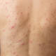 Recomendaciones para eliminar el acné de la espalda