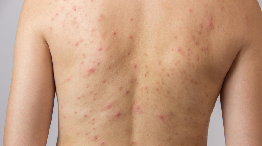 Recomendaciones para eliminar el acné de la espalda | El Imparcial de Oaxaca