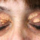 Xantelasmas o manchas blancas alrededor de los ojos