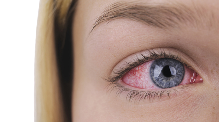 Conjuntivitis aumenta en temporada de invierno