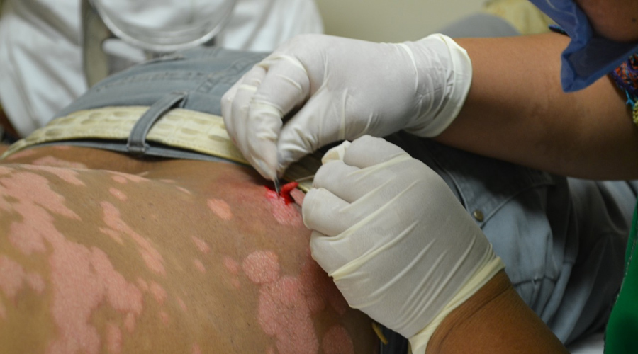 Anuncian jornada de detección de lepra en el Istmo | El Imparcial de Oaxaca