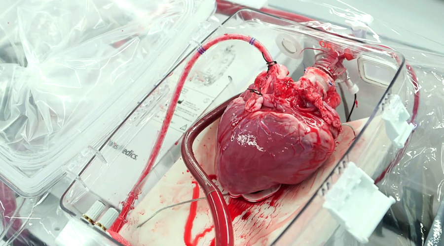 Ya es posible un transplante sin donador, con corazones artificiales | El Imparcial de Oaxaca
