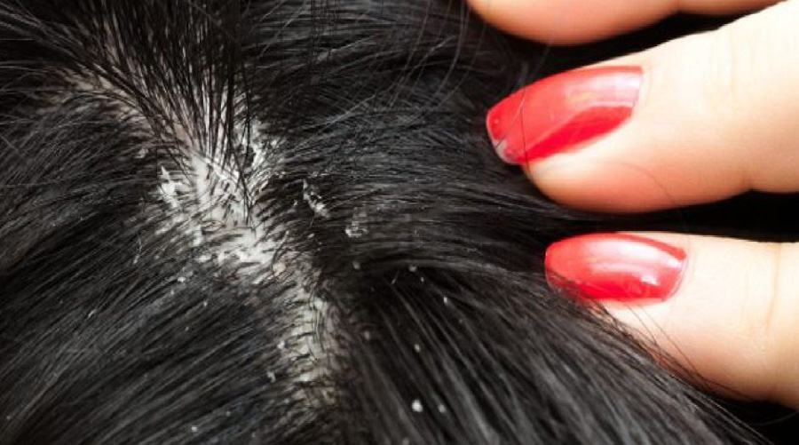 Dile adiós a la caspa en tu cabello con un tratamiento de huevo | El Imparcial de Oaxaca