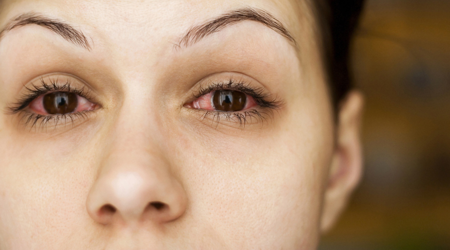 Cómo prevenir y tratar las alergias en los ojos
