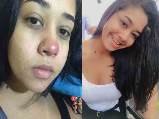 Joven termina parapléjica luego de que piercing en la nariz se le infectara | El Imparcial de Oaxaca
