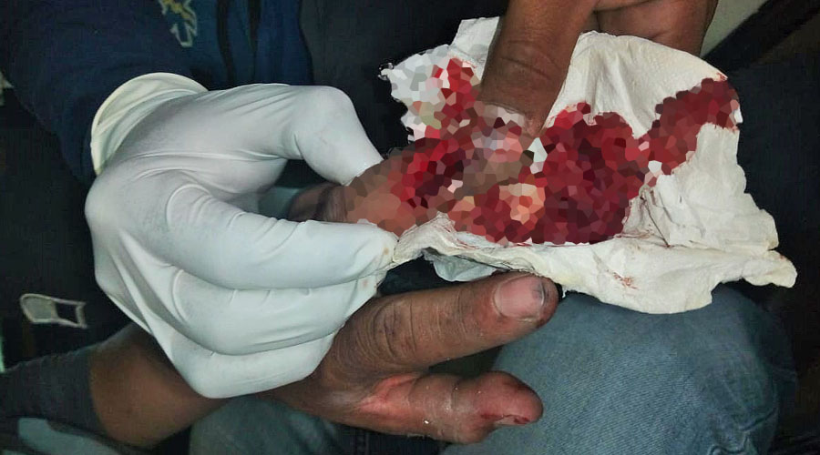 Pierde el dedo tras ser atropellado por urbano | El Imparcial de Oaxaca