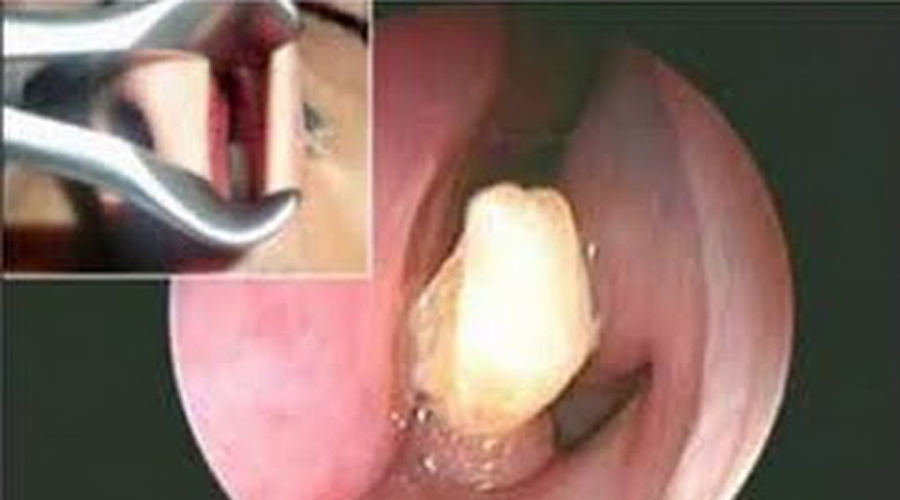 Hombre descubre que un diente creció dentro de su nariz | El Imparcial de Oaxaca
