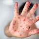 Desmitificar las vacunas para evitar el sarampión