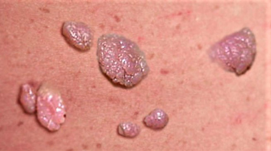 Resultado de imagen de HPV