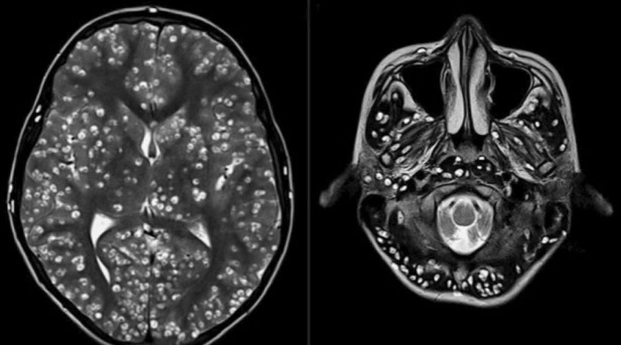 Muere joven de 18 años, su cerebro estaba infectado de larvas