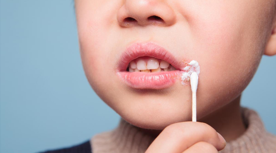 Temperaturas extremas causan herpes labial: IMSS