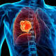 Desarrollan sistema para detectar cáncer de pulmón en el IPN