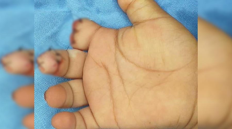 Bebé de dos años pierde dos dedos al meterlos en molino | El Imparcial de Oaxaca