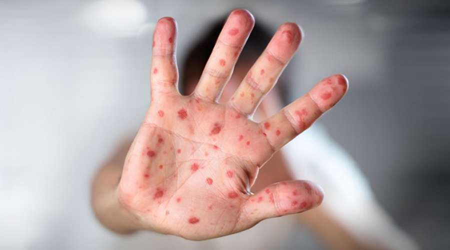 Aumentan los casos de sarampión en el mundo | El Imparcial de Oaxaca