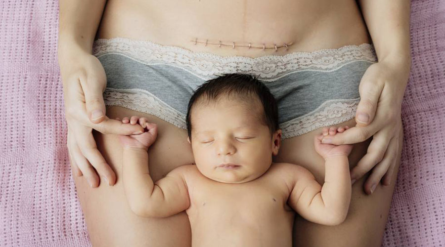 Así debes de cuidar tu herida tras un parto por cesárea | El Imparcial de Oaxaca