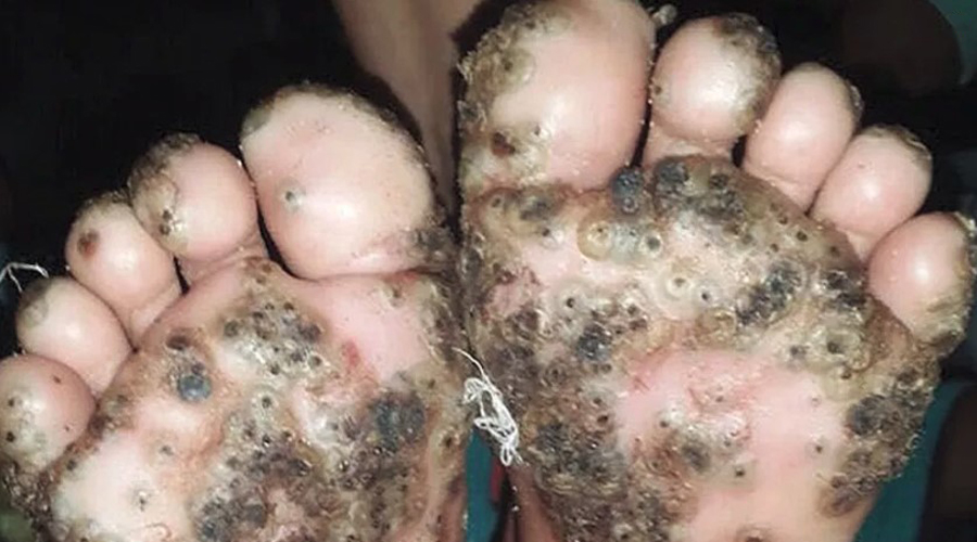 Niña se infesta de pulgas por caminar descalza | El Imparcial de Oaxaca