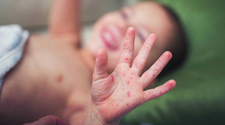 Alertan sobre posible epidemia de sarampión en el mundo