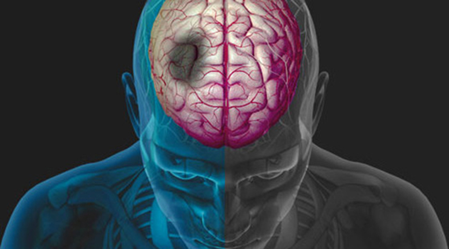 Los primeros síntomas de un infarto cerebral