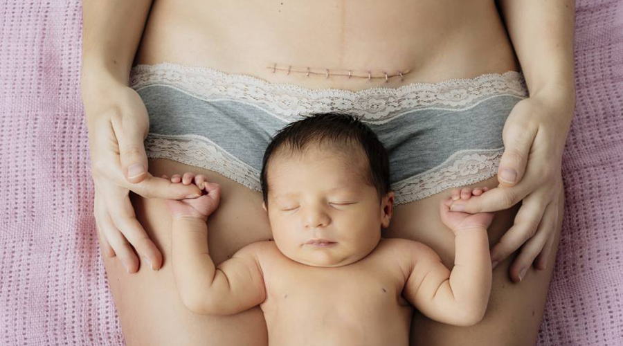 ¿Realmente una cesárea duele menos que el parto natural? Acá te diremos la verdad | El Imparcial de Oaxaca