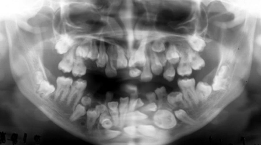 Realizan cirugía a niño de siete años para extraerle 500 dientes | El Imparcial de Oaxaca Realizan cirugía a niño de siete años para extraerle 500 dientes | El Imparcial de Oaxaca