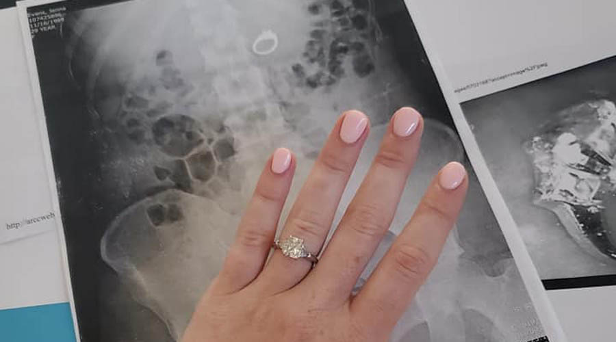 Mujer se traga su anillo de compromiso porque soño que se lo robaban