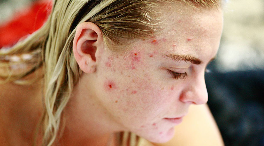 Conoce las causas y tratamientos del acné | El Imparcial de Oaxaca