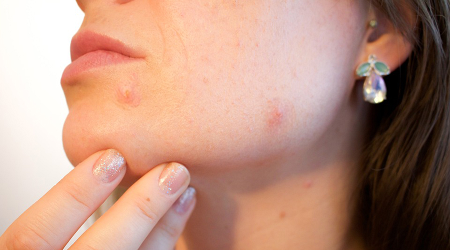 Elimina las marcas de acné en la piel de tu rostro | El Imparcial de Oaxaca