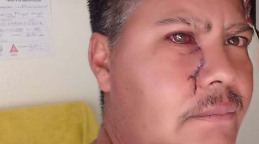 Árbitro pierde el ojo por golpes de futbolista en liga amateur | El Imparcial de Oaxaca