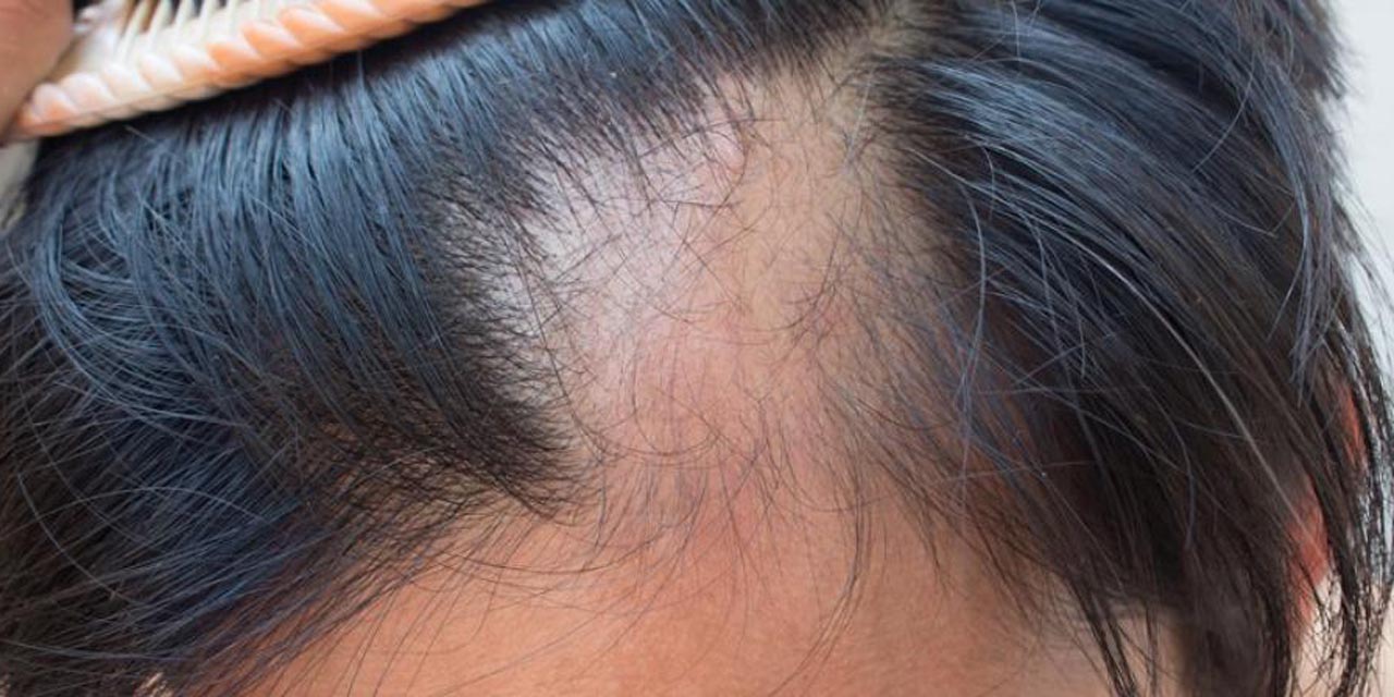Pacientes recuperados de Covid-19 presentan caída de cabello de forma continúa | El Imparcial de Oaxaca