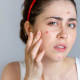 Checa algunos consejos para combatir el acné