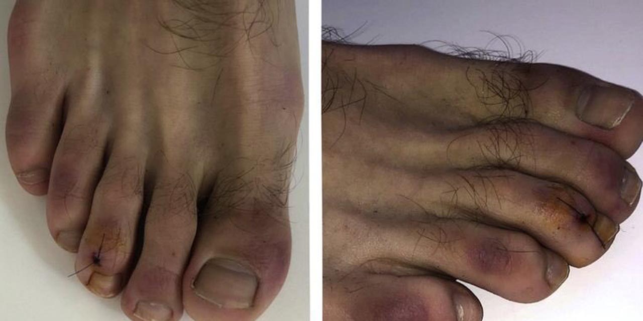 Covid-19 puede cambiar el color de los dedos de los pies hasta por cinco meses | El Imparcial de Oaxaca