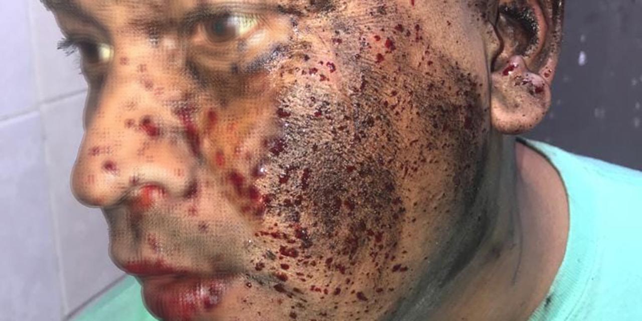 Hombre intenta encender pirotecnia y le explota en la cara | El Imparcial de Oaxaca